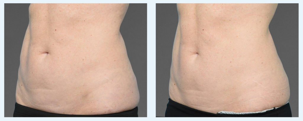 cooltone female before and after surgery | Young Medical Spa | Central Valley PA, Lansdale PA, Forty Port PA