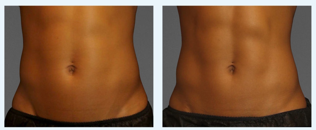 cooltone female abdomen before and after | Young Medical Spa | Central Valley PA, Lansdale PA, Forty Port PA
