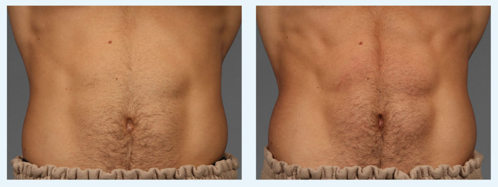 cooltone male abdomen before and after | Young Medical Spa | Central Valley PA, Lansdale PA, Forty Port PA
