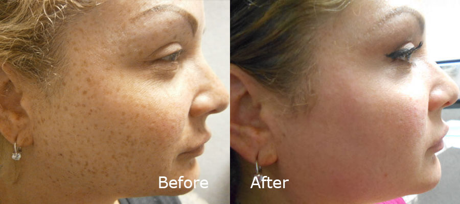Facetite Treatment Before and after patient 1 | Young Medical Spa | Central Valley PA, Lansdale PA, Forty Port PA