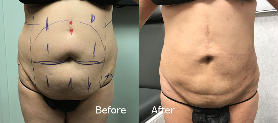 Bodytite before and after patient 5 | Young Medical Spa | Central Valley PA, Lansdale PA, Forty Port PA