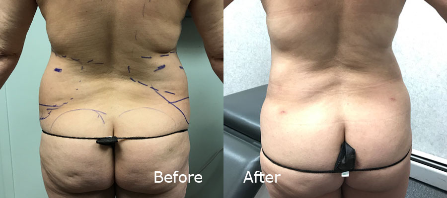 Bodytite before and after patient 6 | Young Medical Spa | Central Valley PA, Lansdale PA, Forty Port PA