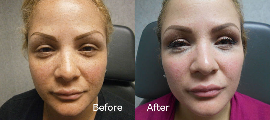 Facetite Treatment Before and after patient 2 | Young Medical Spa | Central Valley PA, Lansdale PA, Forty Port PA