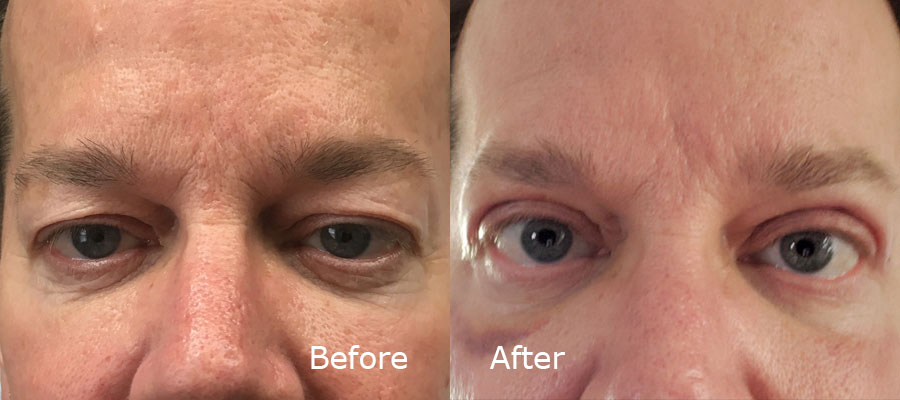 Botox Treatment before and after patient 1 | Young Medical Spa | Central Valley PA, Lansdale PA, Forty Port PA