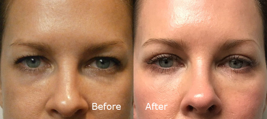 Botox Treatment before and after patient 2 | Young Medical Spa | Central Valley PA, Lansdale PA, Forty Port PA