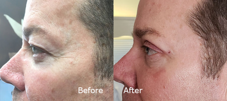 Botox Treatment before and after patient 3 | Young Medical Spa | Central Valley PA, Lansdale PA, Forty Port PA