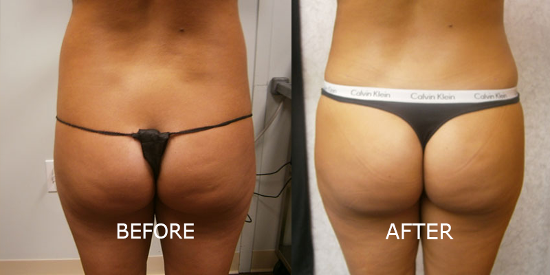 BBL before and after patient 2 | Young Medical Spa | Central Valley PA, Lansdale PA, Forty Port PA