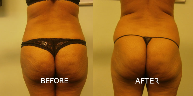 BBL before and after patient 1 | Young Medical Spa | Central Valley PA, Lansdale PA, Forty Port PA