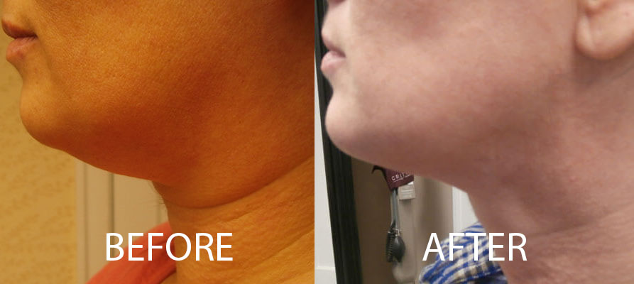 Facetite before and after left view patient 1 | Young Medical Spa | Central Valley PA, Lansdale PA, Forty Port PA