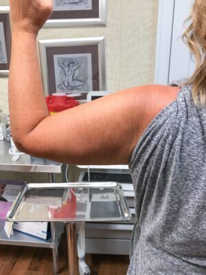 Bodytite left arm after | Young Medical Spa | Central Valley PA, Lansdale PA, Forty Port PA