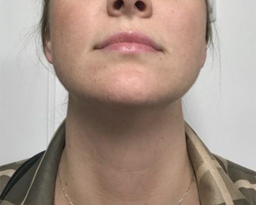 Facetite AFter Front View | Young Medical Spa | Central Valley PA, Lansdale PA, Forty Port PA