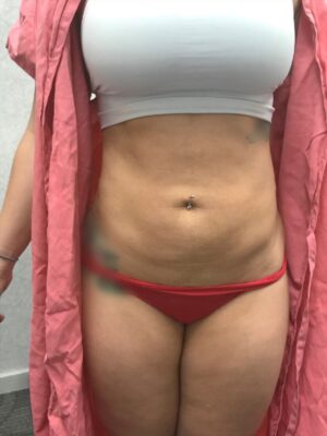 Bodytite after | Young Medical Spa | Central Valley PA, Lansdale PA, Forty Port PA