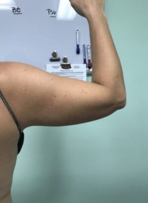 Bodytite right arm before | Young Medical Spa | Central Valley PA, Lansdale PA, Forty Port PA