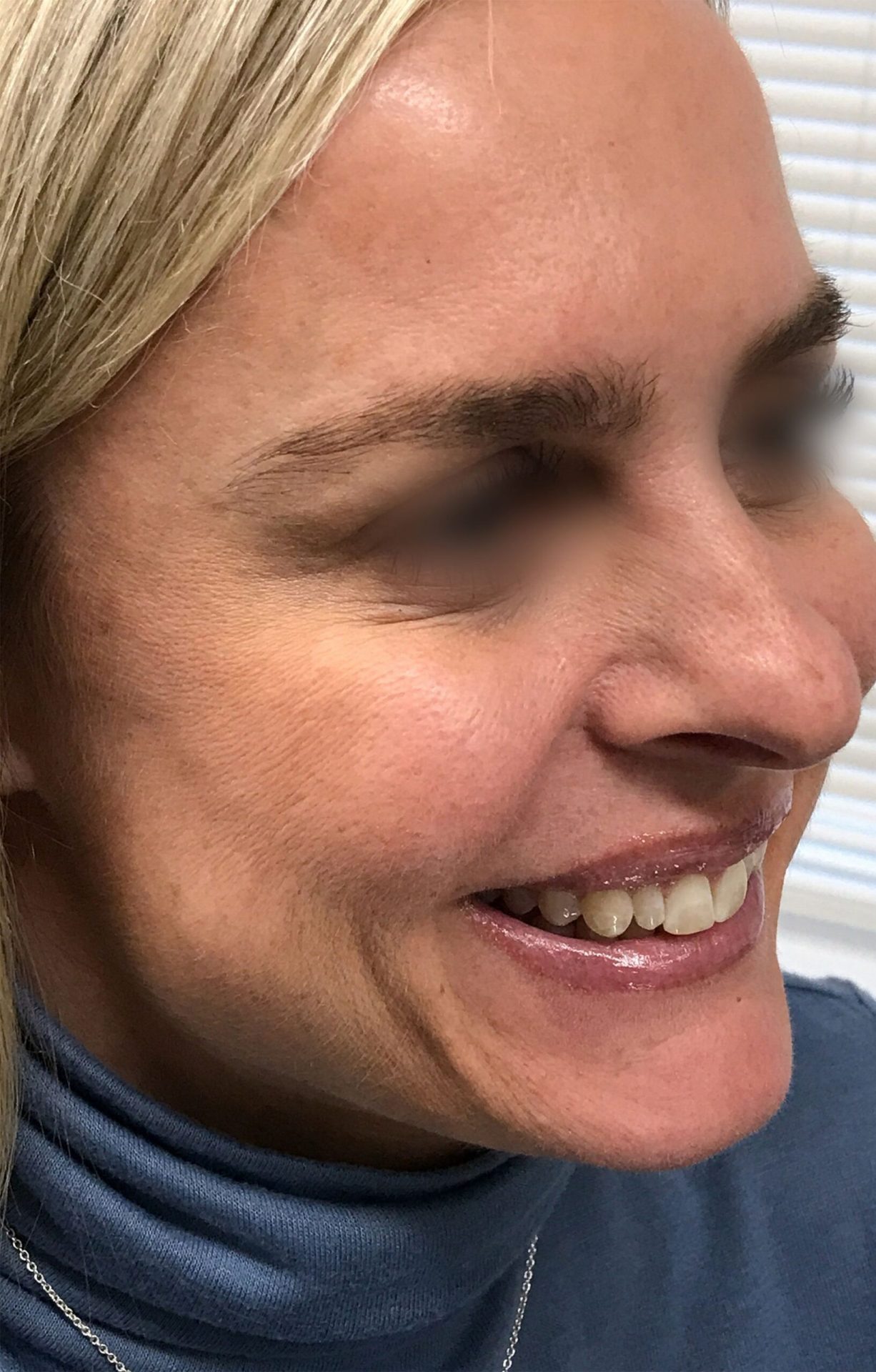 Lip Filler after | Young Medical Spa | Central Valley PA, Lansdale PA, Forty Port PA