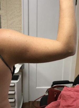 Bodytite right arm after | Young Medical Spa | Central Valley PA, Lansdale PA, Forty Port PA