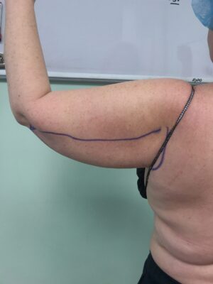 Bodytite left arm before | Young Medical Spa | Central Valley PA, Lansdale PA, Forty Port PA