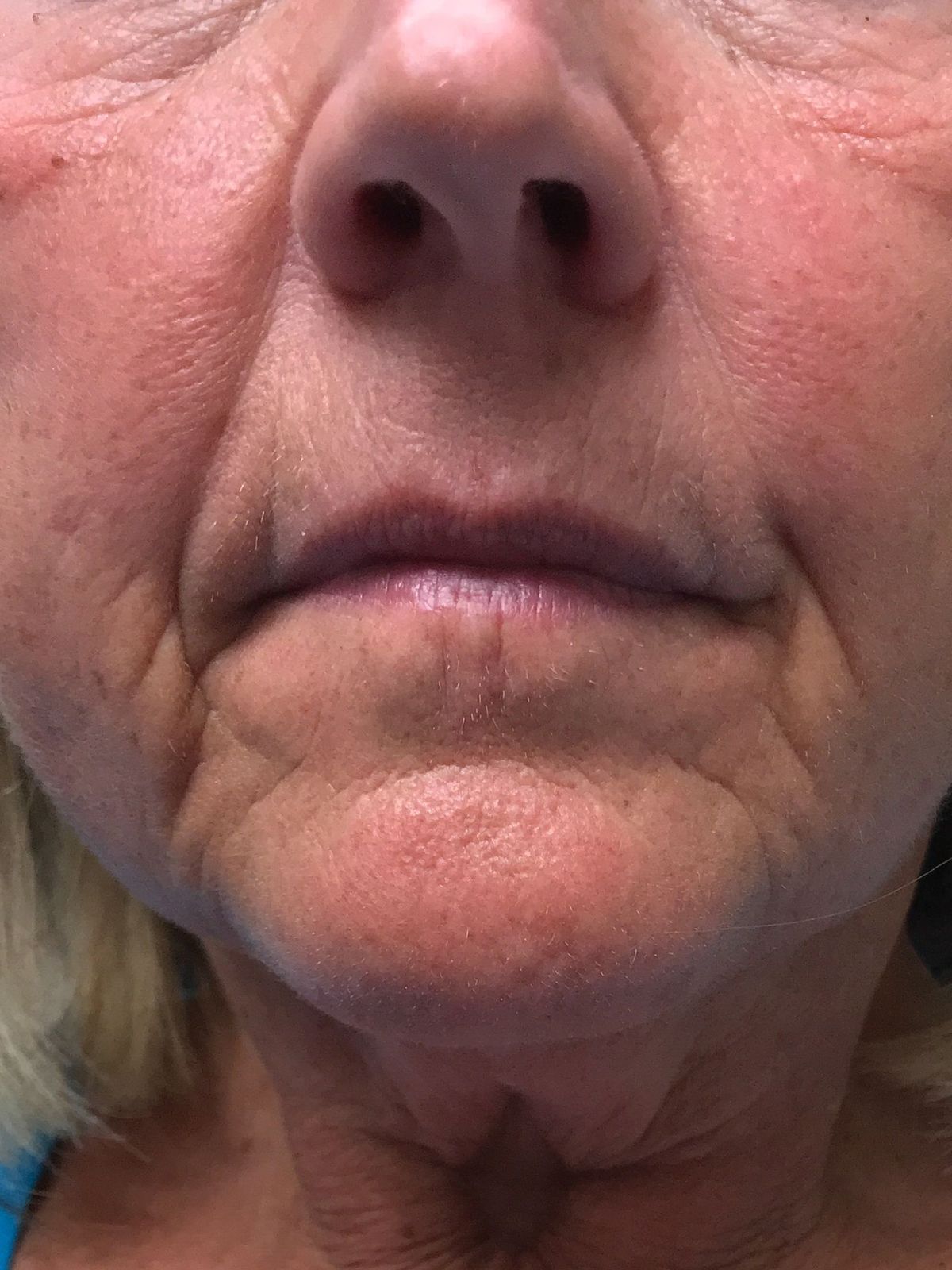 Lip Filler before Treatment | Young Medical Spa | Central Valley PA, Lansdale PA, Forty Port PA