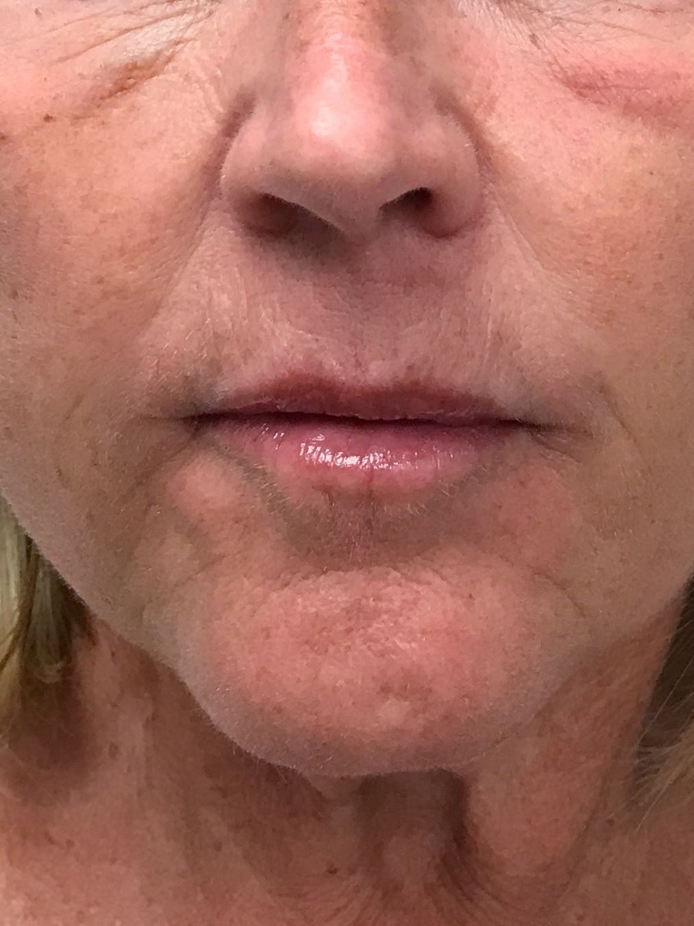 Lip filler After | Young Medical Spa | Central Valley PA, Lansdale PA, Forty Port PA