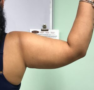Body Tite After Patient 12 Back Right Arm | Young Medical Spa | Central Valley PA, Lansdale PA, Forty Port PA