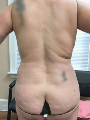 Body Tite After Patient 7 Back View | Young Medical Spa | Central Valley PA, Lansdale PA, Forty Port PA