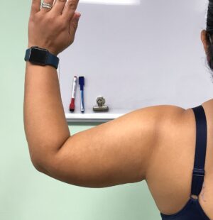 Body Tite After Patient 12 Back Left Arm | Young Medical Spa | Central Valley PA, Lansdale PA, Forty Port PA