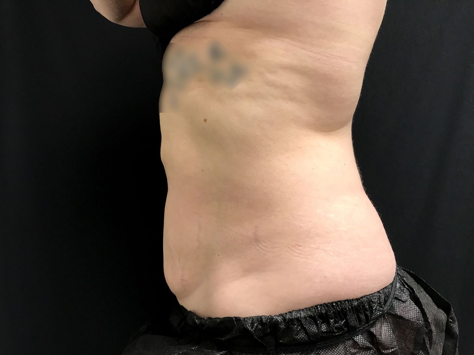 Coolsculpting After Patient 3 Left View | Young Medical Spa | Central Valley PA, Lansdale PA, Forty Port PA