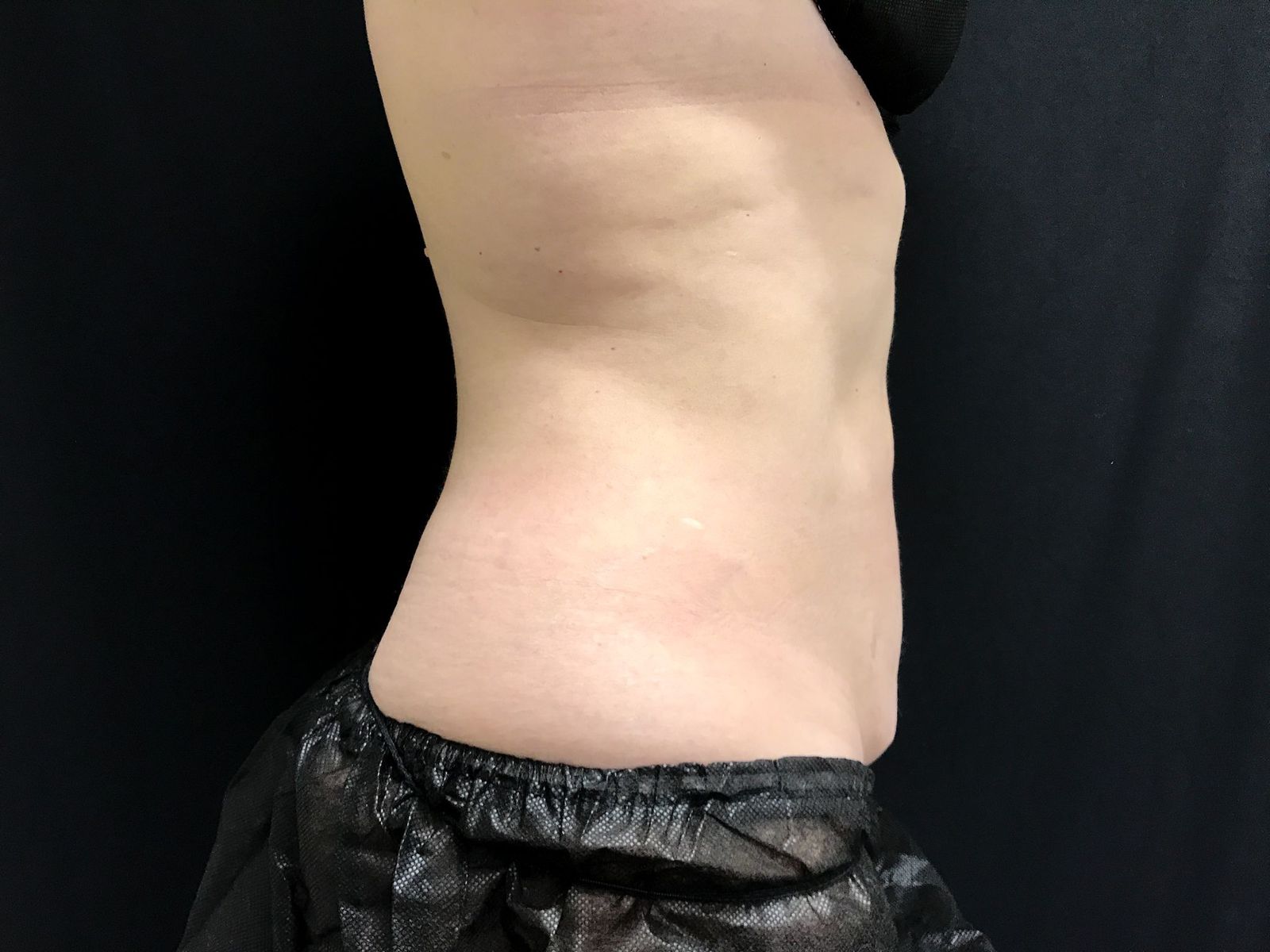 Coolsculpting After Patient 3 Right View | Young Medical Spa | Central Valley PA, Lansdale PA, Forty Port PA