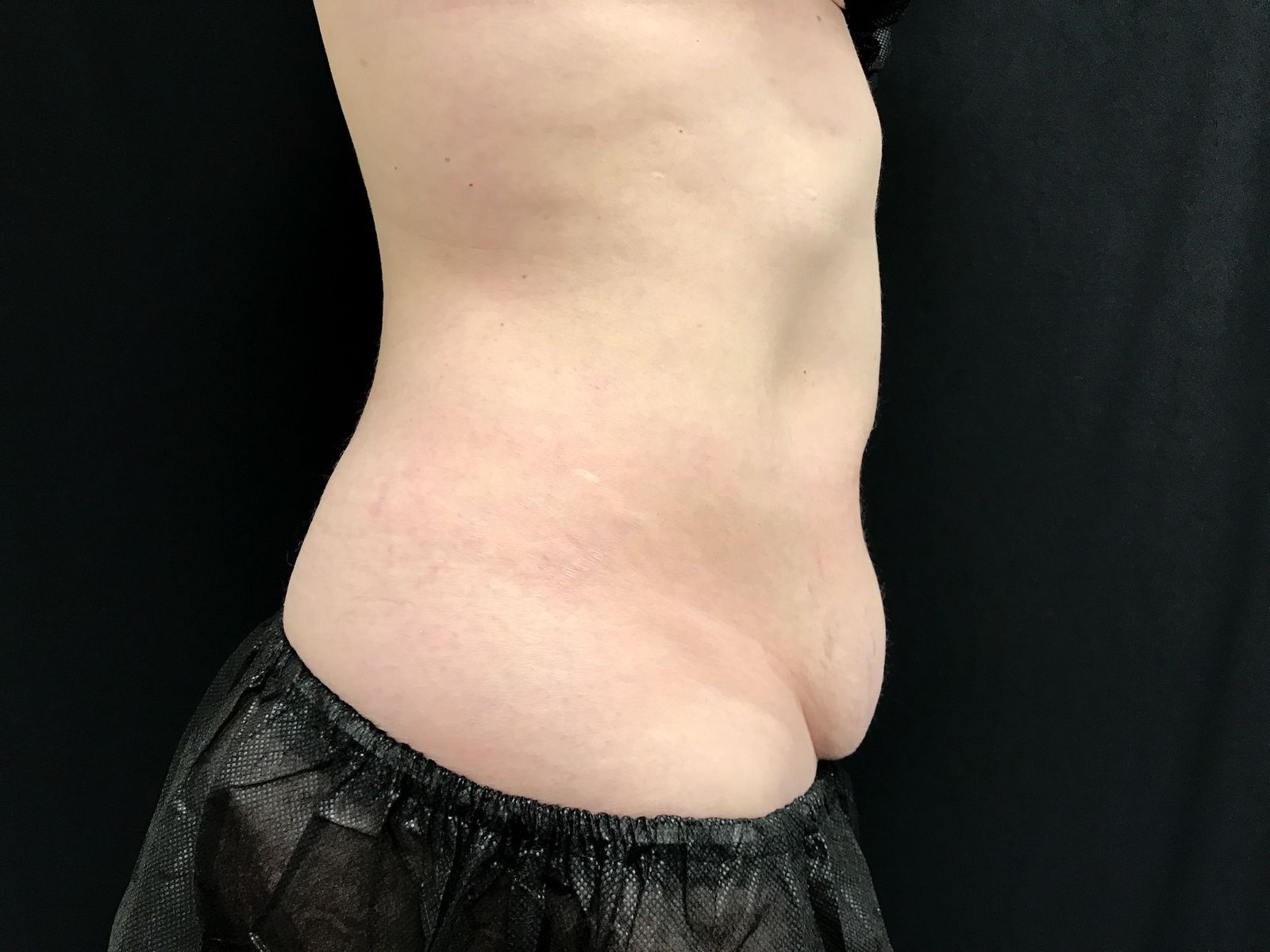 Coolsculpting Before Patient 3 Right View | Young Medical Spa | Central Valley PA, Lansdale PA, Forty Port PA