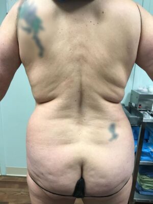 Body Tite Before Patient 7 Back View | Young Medical Spa | Central Valley PA, Lansdale PA, Forty Port PA