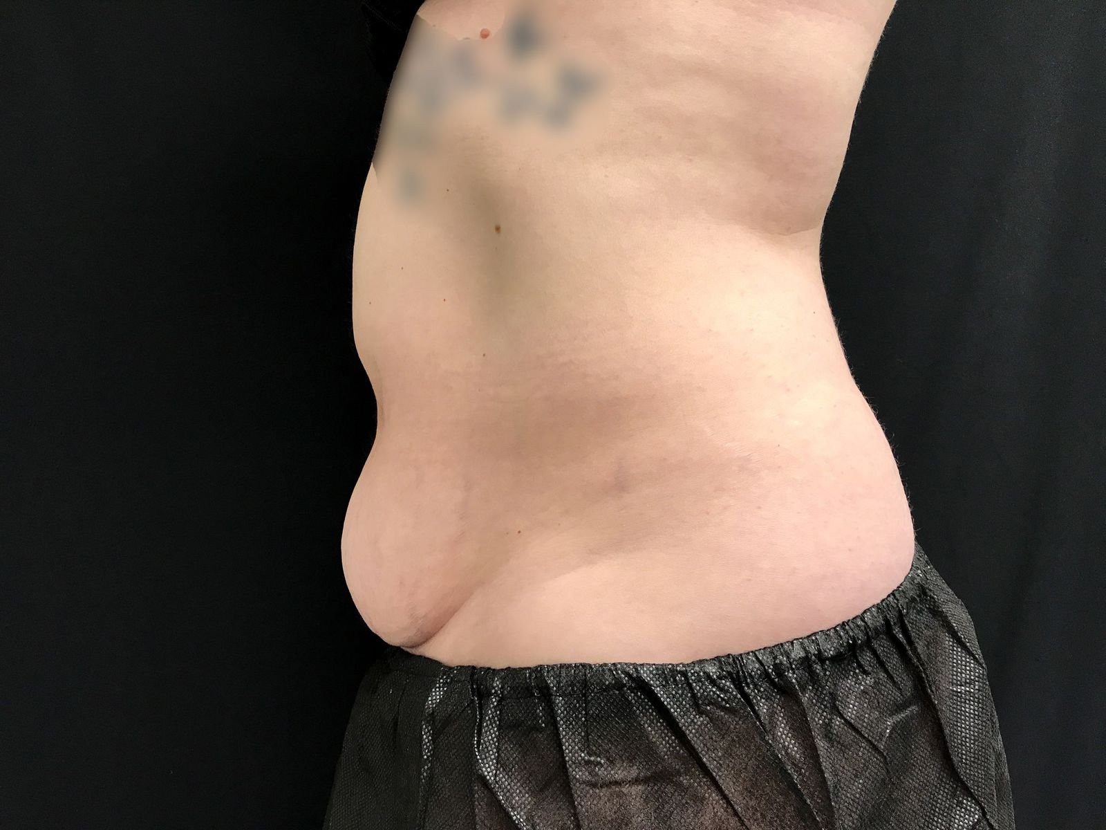 Coolsculpting Before Patient 3 Left View | Young Medical Spa | Central Valley PA, Lansdale PA, Forty Port PA