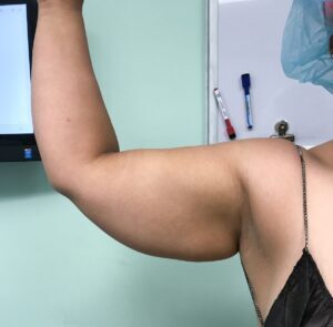 Body Tite Before Patient 12 Right Arm | Young Medical Spa | Central Valley PA, Lansdale PA, Forty Port PA