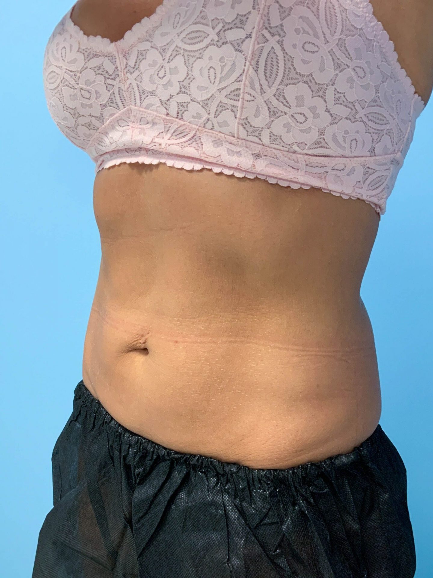 SmartLipo Laser Liposuction After | Young Medical Spa | Central Valley PA, Lansdale PA, Forty Port PA