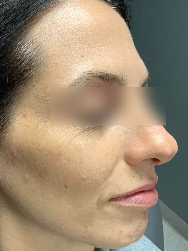 Facetite Surgery Right View Treatment After | Young Medical Spa | Central Valley PA, Lansdale PA, Forty Port PA