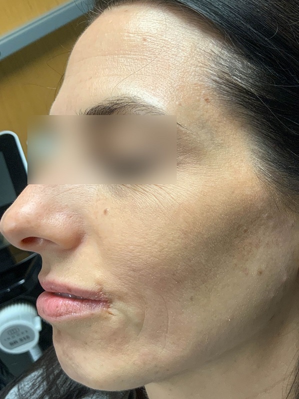 Facetite Surgery Left View Treatment After | Young Medical Spa | Central Valley PA, Lansdale PA, Forty Port PA
