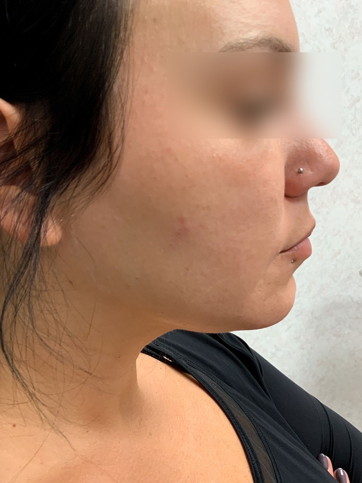 Facetite Surgery After Side View | Young Medical Spa | Central Valley PA, Lansdale PA, Forty Port PA