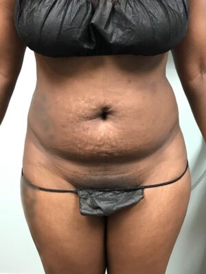 SmartLipo Laser Liposuction Front View Before | Young Medical Spa | Central Valley PA, Lansdale PA, Forty Port PA