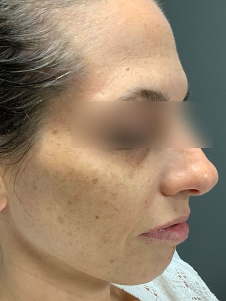 Facetite Surgery Right View Treatment Before | Young Medical Spa | Central Valley PA, Lansdale PA, Forty Port PA