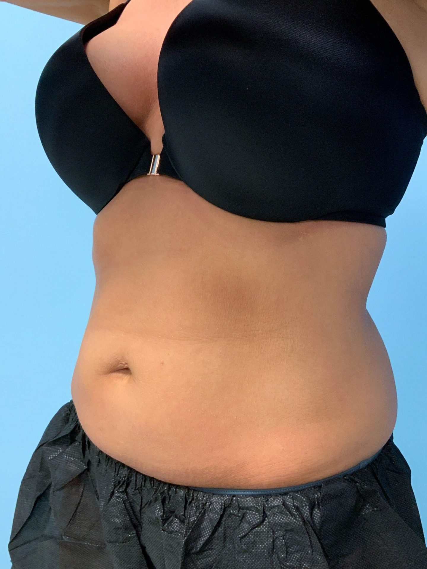 SmartLipo Laser Liposuction before | Young Medical Spa | Central Valley PA, Lansdale PA, Forty Port PA