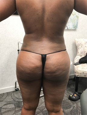 HD-Lipo Butt Lift After Surgery | Young Medical Spa | Lansdale PA