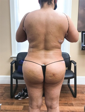 Butt Lift Surgery After | Young Medical Spa | Central Valley PA