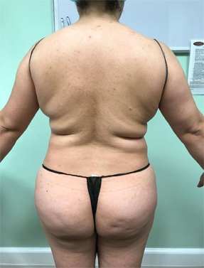 Butt Lift Before Surgery Before | Young Medical Spa | Forty Port PA