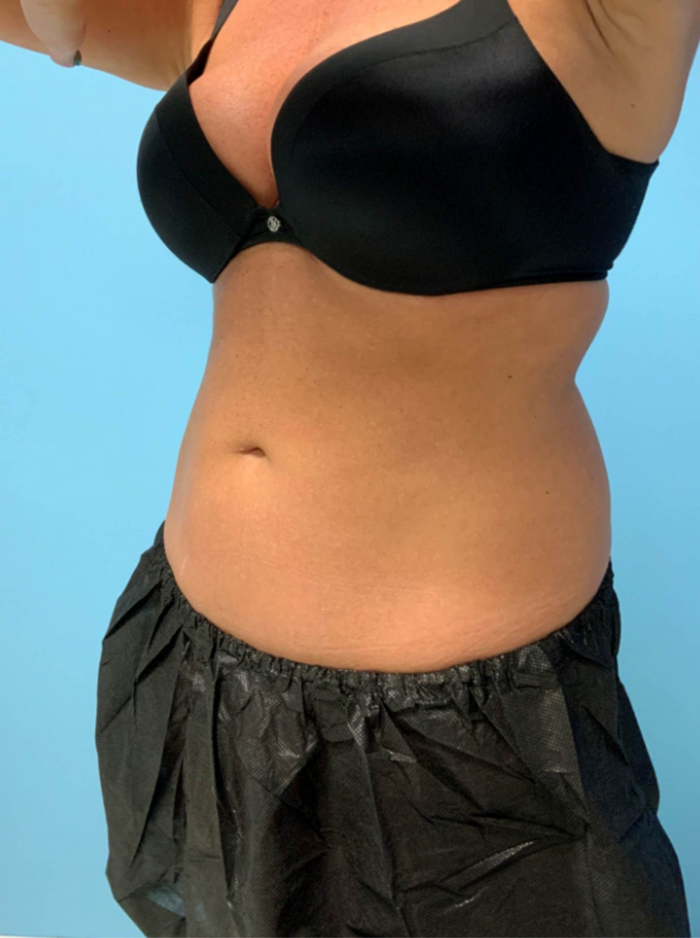 SmartLipo Laser Liposuction Left View After | Young Medical Spa | Central Valley PA, Lansdale PA, Forty Port PA
