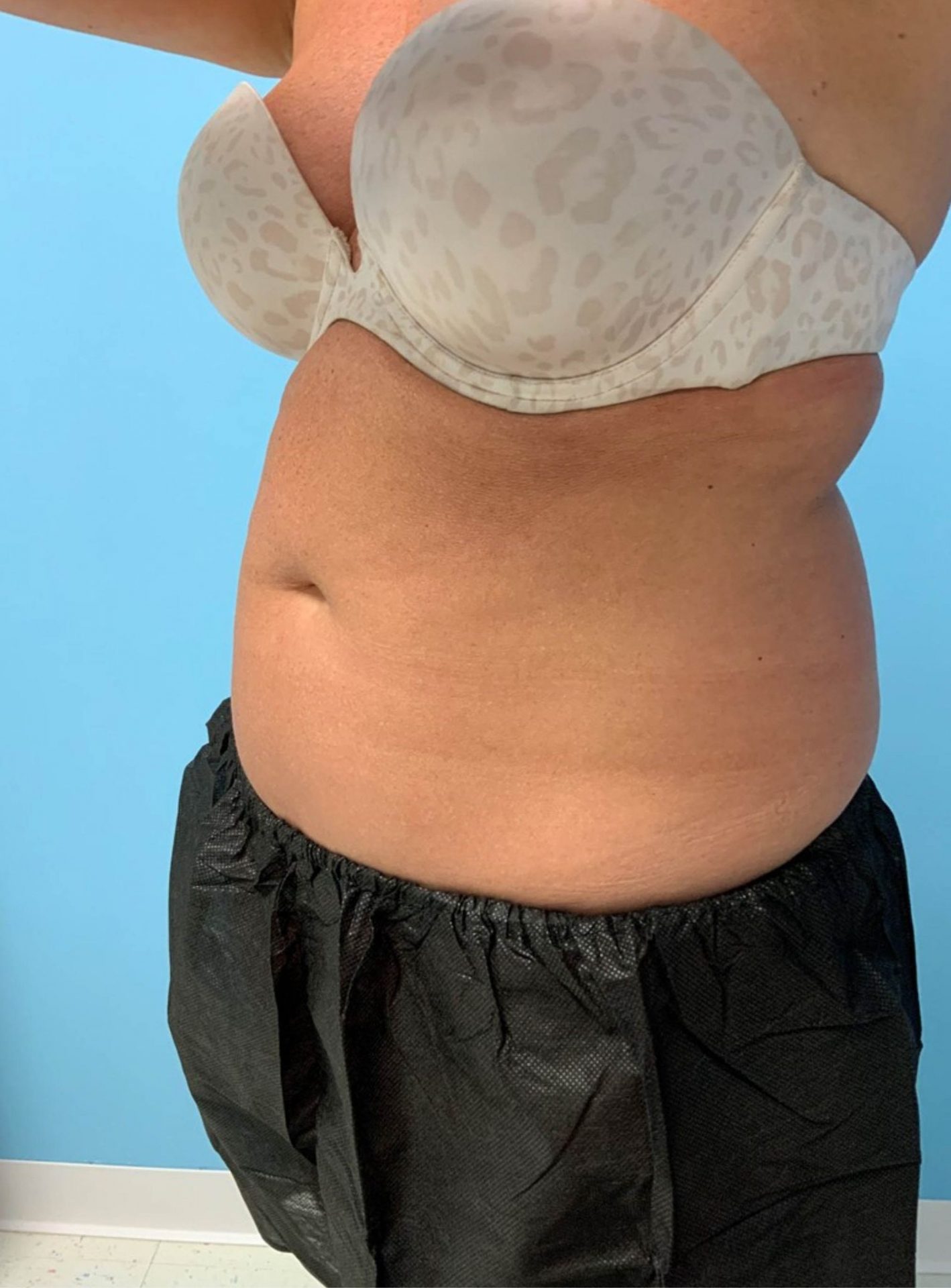 SmartLipo Laser Liposuction left View Before | Young Medical Spa | Central Valley PA, Lansdale PA, Forty Port PA