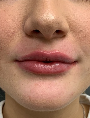 Lip Filler Treatment Front View After | Young Medical Spa | Central Valley PA, Lansdale PA, Forty Port PA