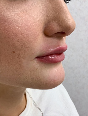 Lip Filler Treatment Right View After | Young Medical Spa | Central Valley PA, Lansdale PA, Forty Port PA