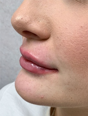 Lip Filler Treatment Left View After | Young Medical Spa | Central Valley PA, Lansdale PA, Forty Port PA