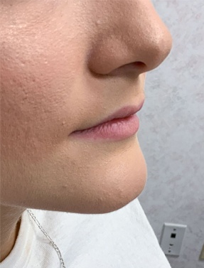 Lip Filler Treatment Right View Before | Young Medical Spa | Central Valley PA, Lansdale PA, Forty Port PA
