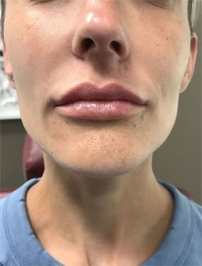 Lip Filler Treatment After | Young Medical Spa | Central Valley PA, Lansdale PA, Forty Port PA