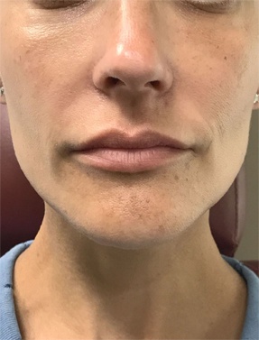 Lip Filler Treatment Before | Young Medical Spa | Central Valley PA, Lansdale PA, Forty Port PA
