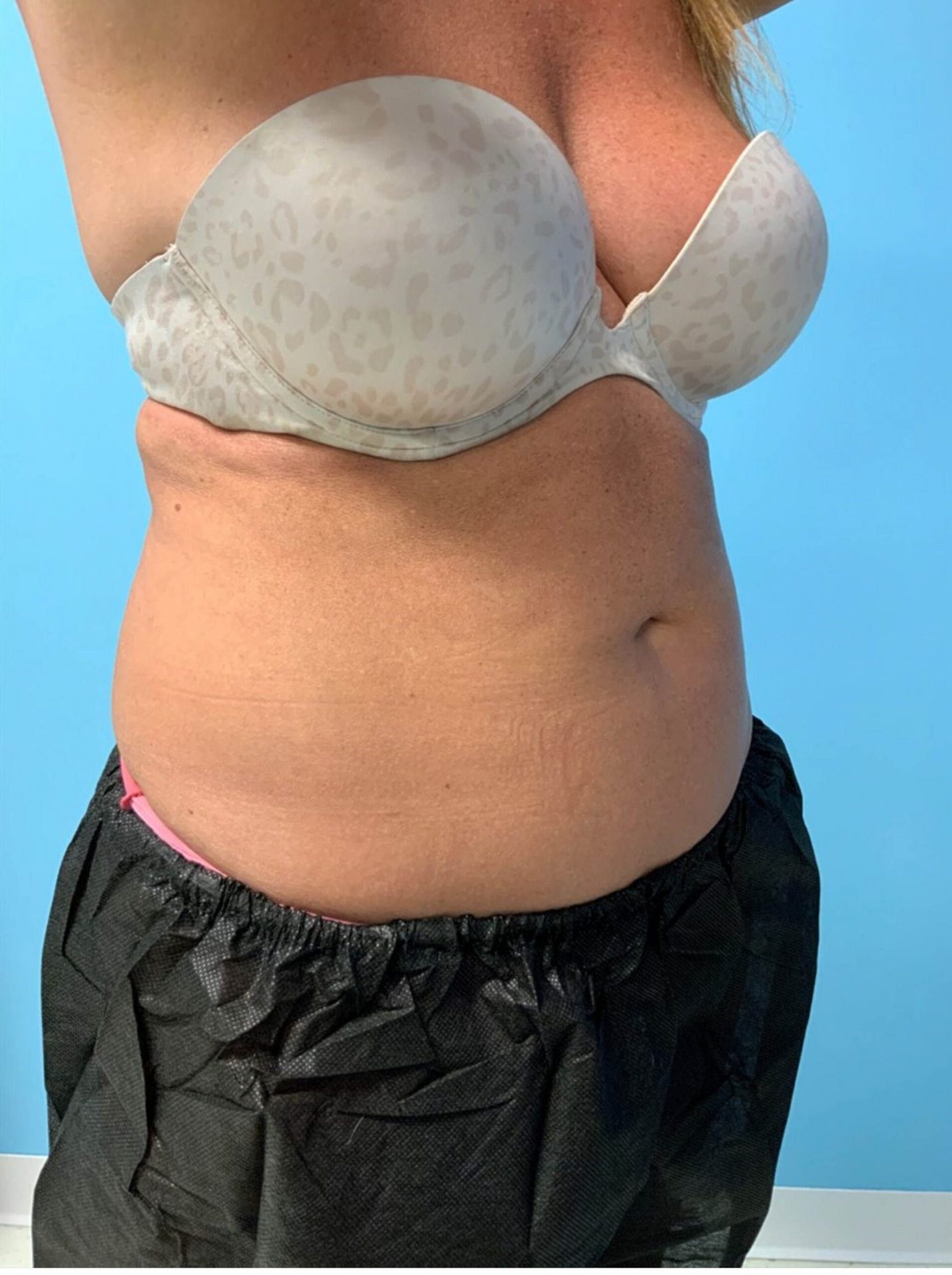SmartLipo Laser Liposuction Right View Before | Young Medical Spa | Central Valley PA, Lansdale PA, Forty Port PA